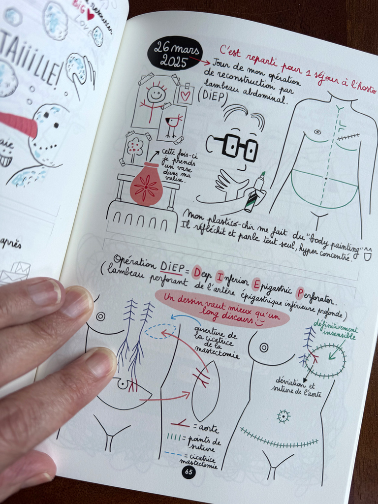 Diep-reconstruction-mammaire-BD-cancer-du-sein.webp